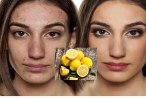 lemon on face tremendous glow pimples and Acne disappear overnight